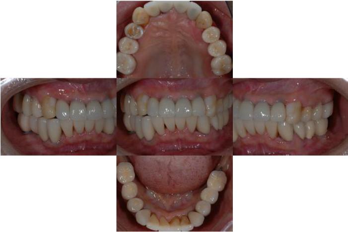 インプラント治療終了後です。
