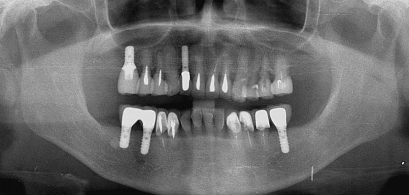 合計5本のインプラントを埋入しました。