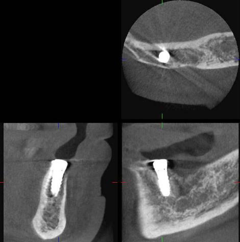 適切な位置に埋入されたことがCTで確認できます。
