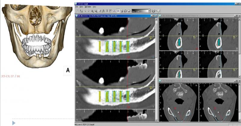 CT上でインプラントの埋入位置を決定しています。