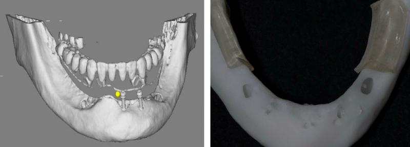 CTをもとに下顎の模型を作成しました。