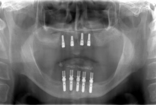 インプラント埋入後のレントゲン写真です。