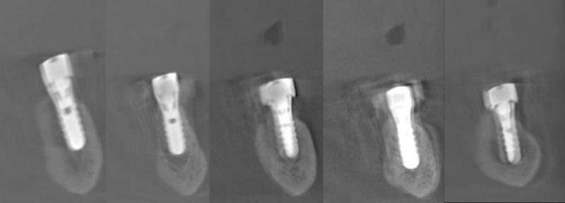 5本のインプラントが適切に埋入されていることがCTで確認できます。