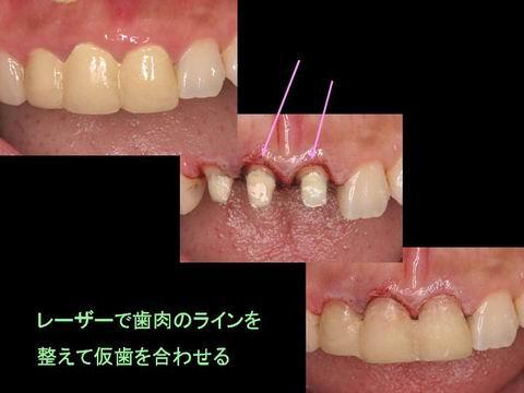 前歯３本の古い被せ物の歯をはずし、レーザーで歯肉のラインを整え、仮歯を調整します。