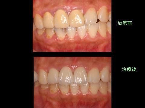 治療前後を比べると変化がわかると思います。　歯のバランスや色の調和が取れているのがお分かりいただけると思います。