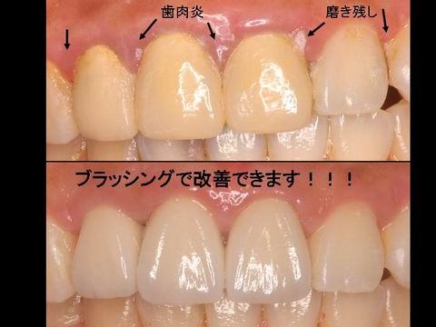 美しい口元の維持のためには、ご自身での適切な清掃や、歯科衛生士による機械的清掃も重要です。歯茎の赤みや腫れた感じが取れているのがお分かりいただけると思います。前歯の見た目が気になる方・自分の笑顔に自身を持ちたいとお考えの方は担当の歯科医師・衛生士にご相談ください。