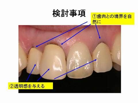 前歯4本のうち一本だけが、自分の歯。他の歯は一般的な保険内でのかぶせ物が入っています。この材料は、作った当初は綺麗な色を再現できますが、使っているうちに透明感がなくなりくすんだ色合いになるという欠点があります。また、歯茎との生態親和性に乏しいため歯茎が下がってしまいます。