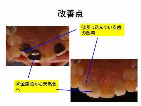 裏から、見たところです。歯並びが悪かった所も改善しました。多少でしたら、かぶせ物で、歯並びをきれいにすることができます。裏から見ても金属がまったく使われていないのがわかると思います。