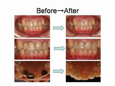 治療前後を比べた写真です。患者さんのご希望するレベルに合わせて、さまざまに治療が可能です。前歯の見た目が気になる方は担当の歯科医師・衛生士にご相談ください。