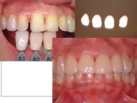 全体的に白くした前歯に対して、形と歯並びの改善を兼ねて、歯を一層（約0.5mmほど）削ります。削った後は色あわせをして（専門の歯科技工士に写真で伝える）、右上にあるように薄い貝殻状のセラミックを作ります。これを丁寧に歯に接着材で貼り付けます。この方法(ラミネートベニアと言います）は①歯を削る量が最小である、②かみ合わせを変えない、③金属を使用しないので色調が自然である、④セラミックは歯肉となじみが良い　などの利点があります。