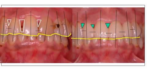 術前に比べ、①歯の方向性、②歯と歯の隙間、③歯の切端の位置、④歯と歯の接触部位などが揃いました。術前の診断が重要となってきます。