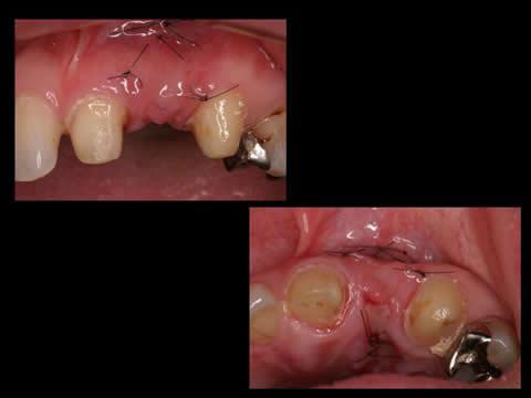 治癒後の状態です。歯のない部分の歯肉に、連続性があることが確認されます。