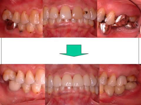金属の色がない自然な修復が完了しました。患者さんは『同窓会では歯の自慢ができた（＾＾）』と喜んでくれました。