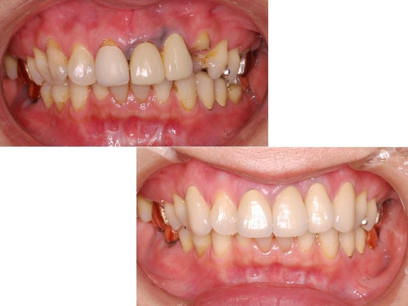 セラミックと歯肉の黒ずみ改善
