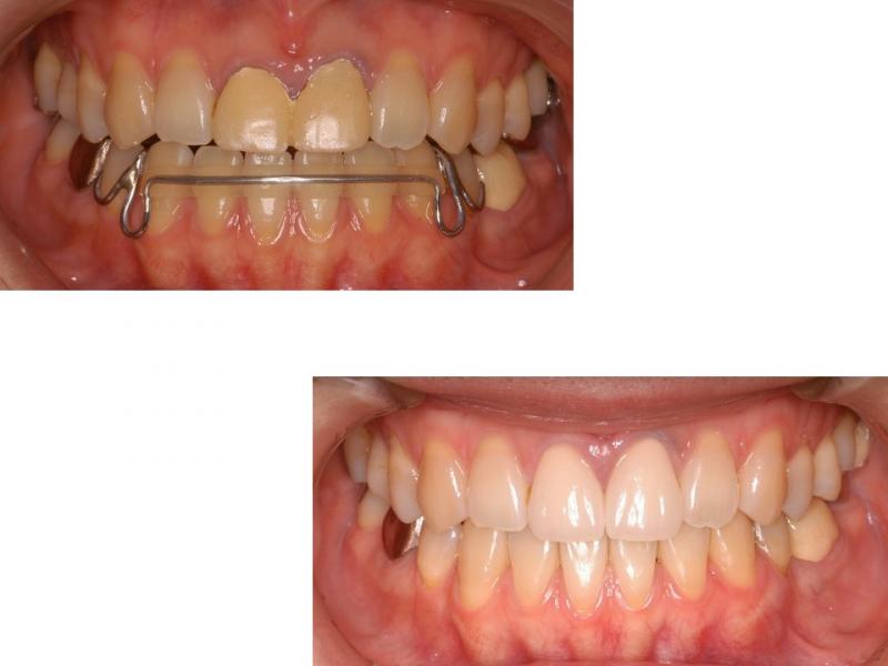 前歯２本をセラミックに