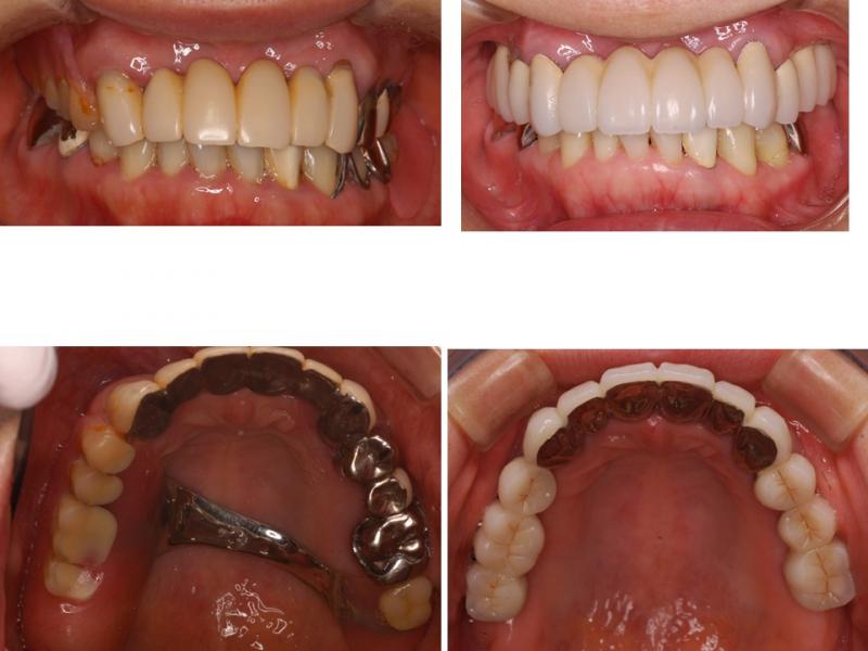 上の義歯をインプラントに