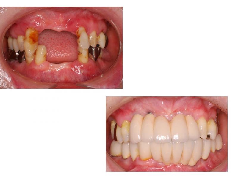 前歯のインプラント（上下）