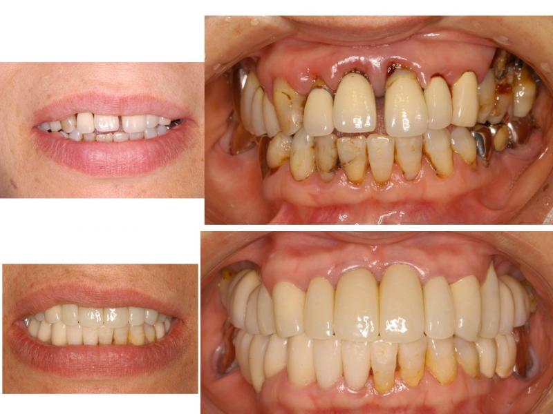 歯周病治療とインプラント・セラミック