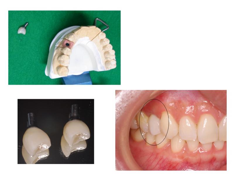 隣の歯を削らないインプラント