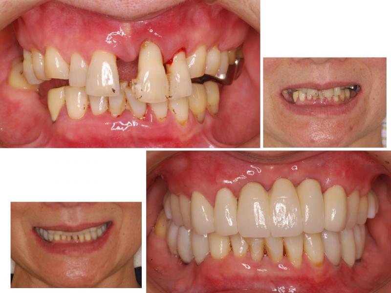 上前歯とした奥歯のインプラントとセラミック