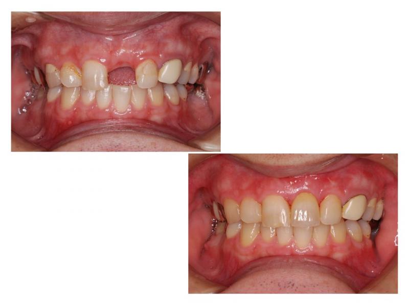 前歯にインプラント