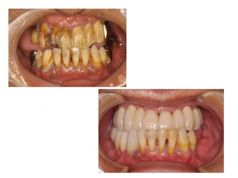 歯周病の治療とセラミック