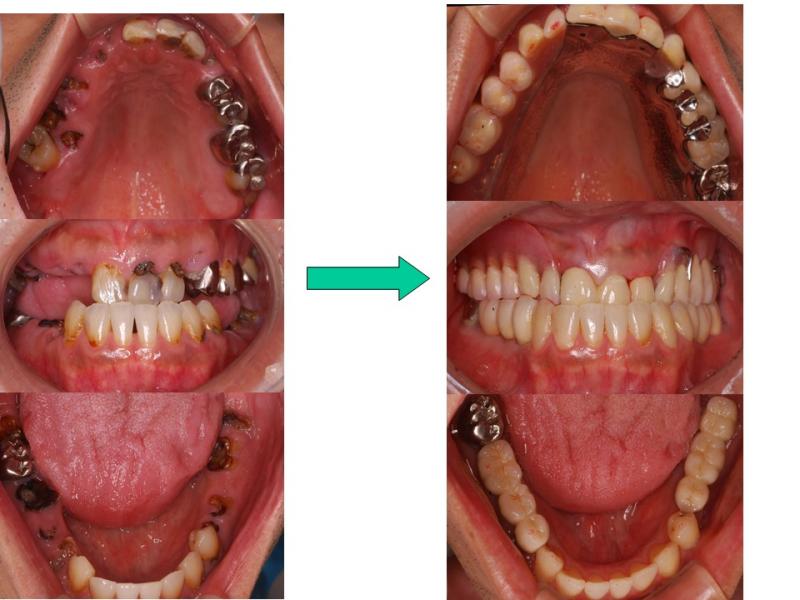 上：バネの見えない義歯<br />下：インプラント